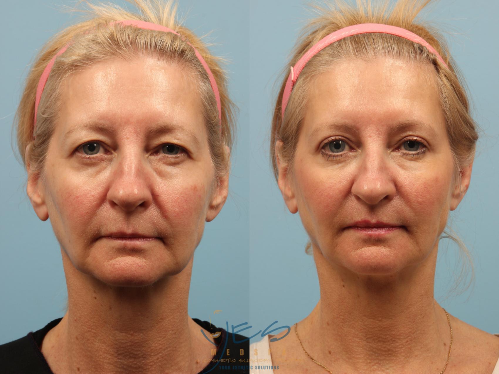 Before & After Brow Lift Case 259 View #1 View in Vancouver, BC