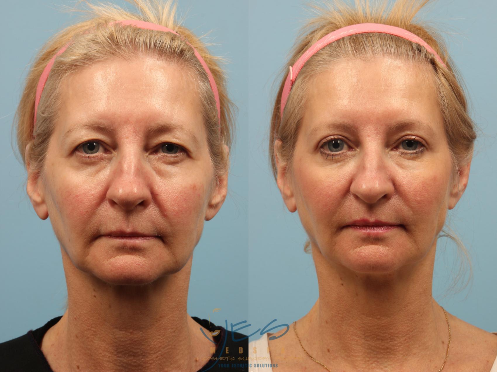 Brow Lift Before And After Photo Gallery Vancouver Bc Yes Medspa And Cosmetic Surgery Centre 