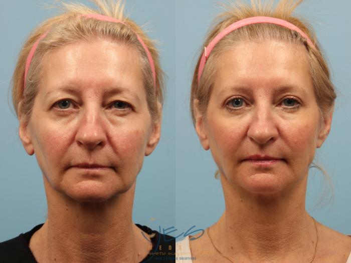 Before & After Brow Lift Case 259 View #1 View in Vancouver, BC