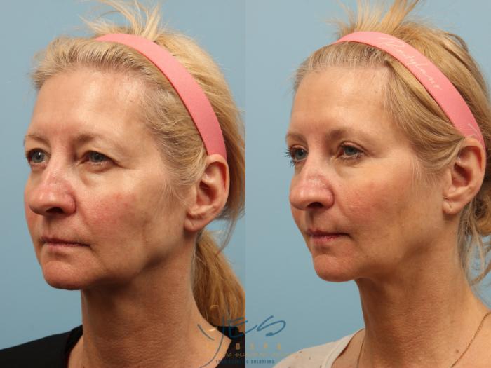 Before & After Brow Lift Case 259 View #2 View in Vancouver, BC