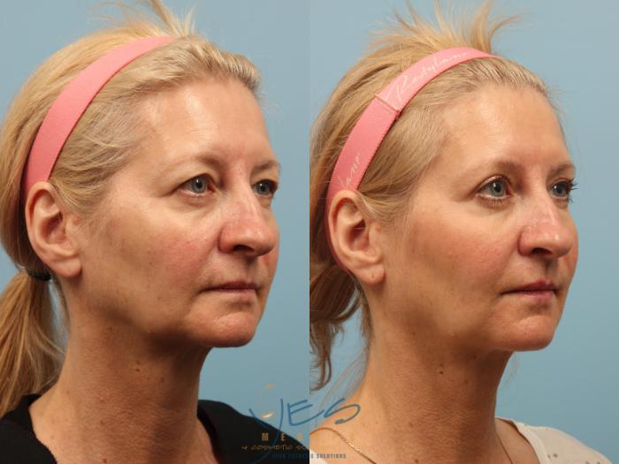 Before & After Brow Lift Case 259 View #3 View in Vancouver, BC