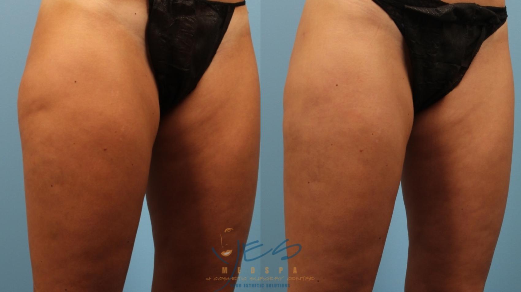 Before & After Cellulaze Case 164 Right Oblique View in Vancouver, BC