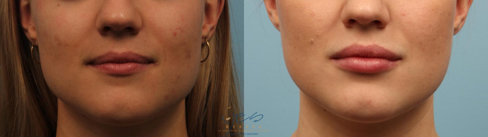 Before & After Dermal Fillers Case 251 Front View in Vancouver, BC