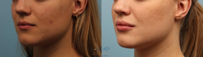 Before & After Dermal Fillers Case 251 Left Oblique View in Vancouver, BC