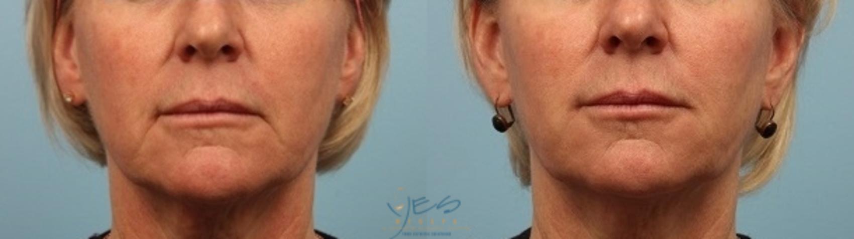 Before & After Dermal Fillers Case 253 View #1 View in Vancouver, BC