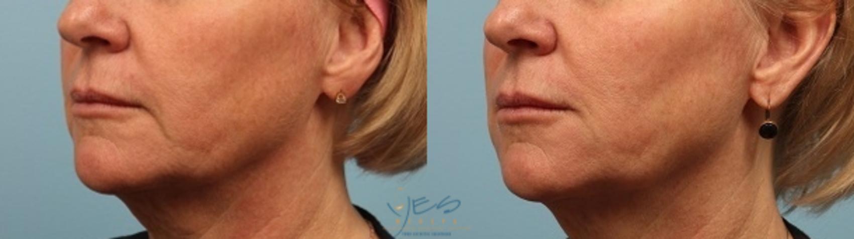 Before & After Dermal Fillers Case 253 View #2 View in Vancouver, BC