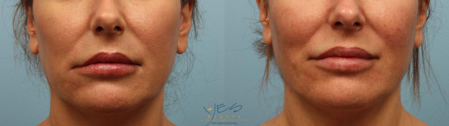 Before & After Dermal Fillers Case 327 Front View in Vancouver, BC