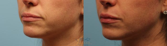 Before & After Dermal Fillers Case 328 Left Oblique View in Vancouver, BC