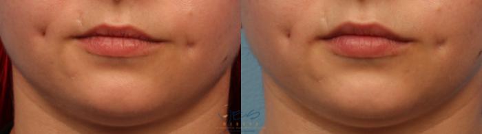 Before & After Dermal Fillers Case 348 Front View in Vancouver, BC