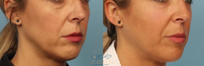 Before & After Dermal Fillers Case 349 Right Oblique View in Vancouver, BC