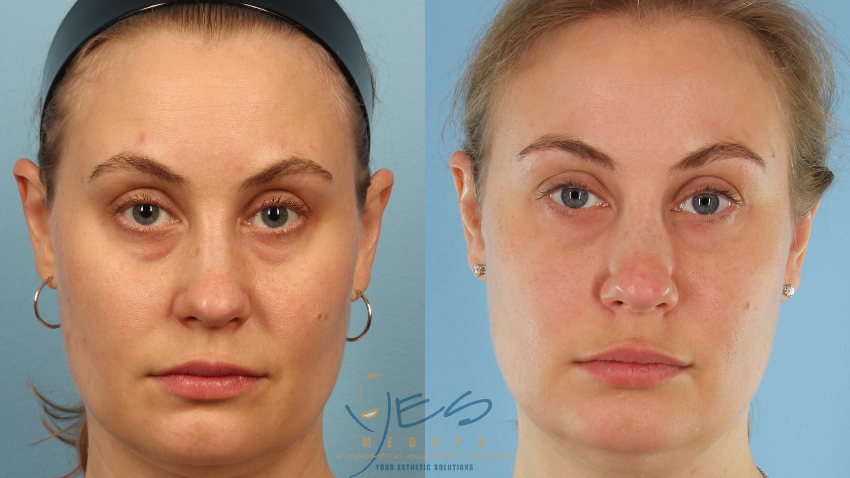 Dermal Fillers Case 358 Before & After Front | Vancouver, BC | YES Medspa & Cosmetic Surgery Centre