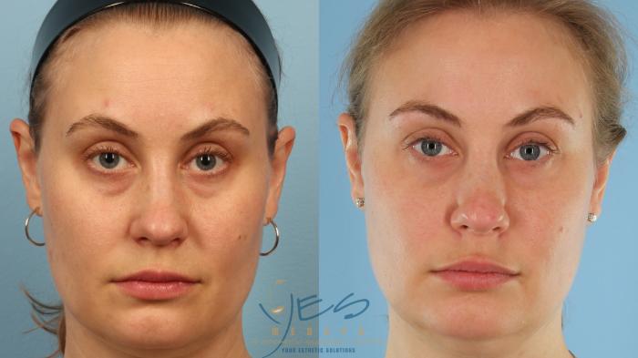 Before & After Dermal Fillers Case 358 Front View in Vancouver, BC