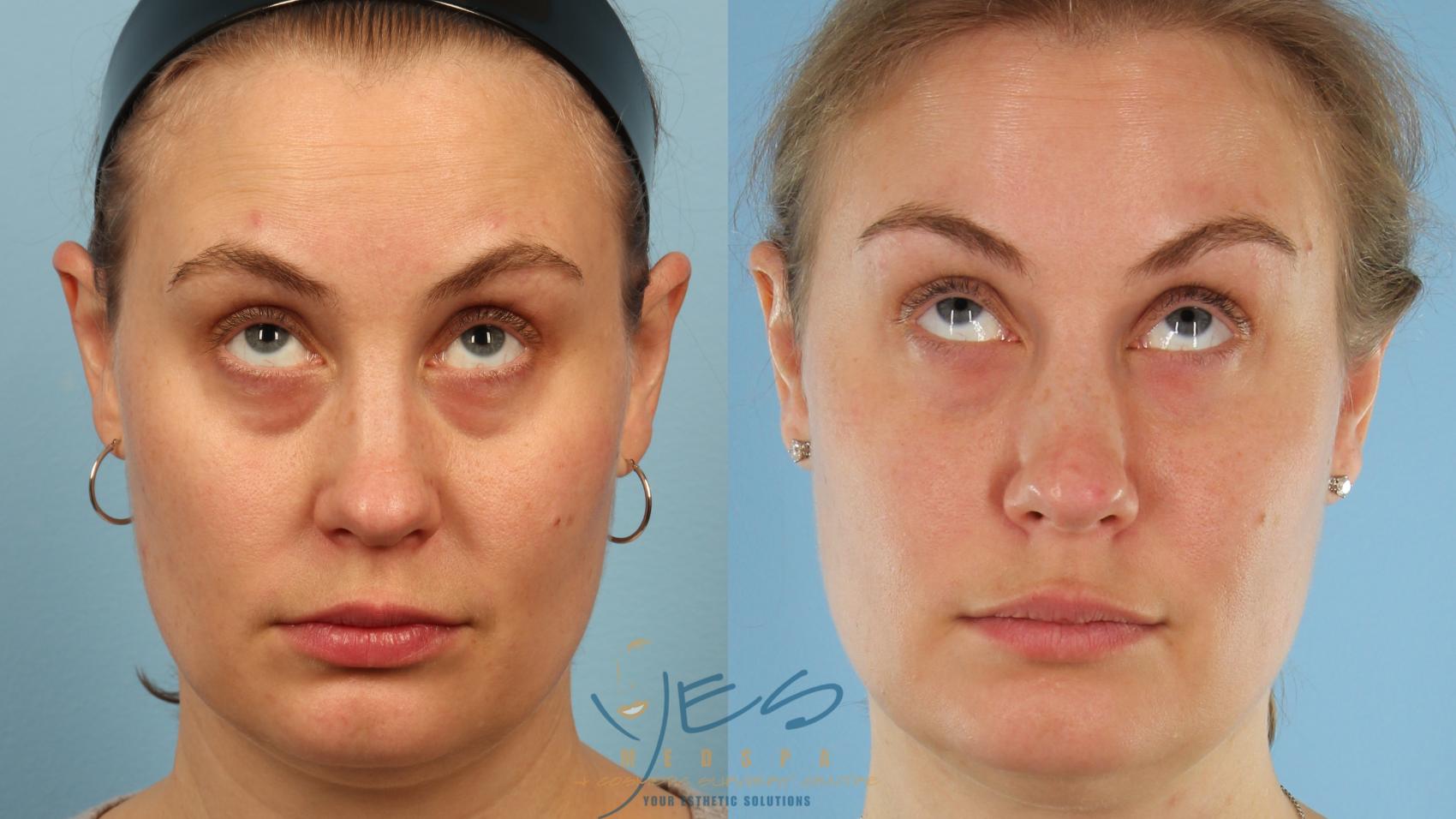 Before & After Dermal Fillers Case 358 Looking Up View in Vancouver, BC