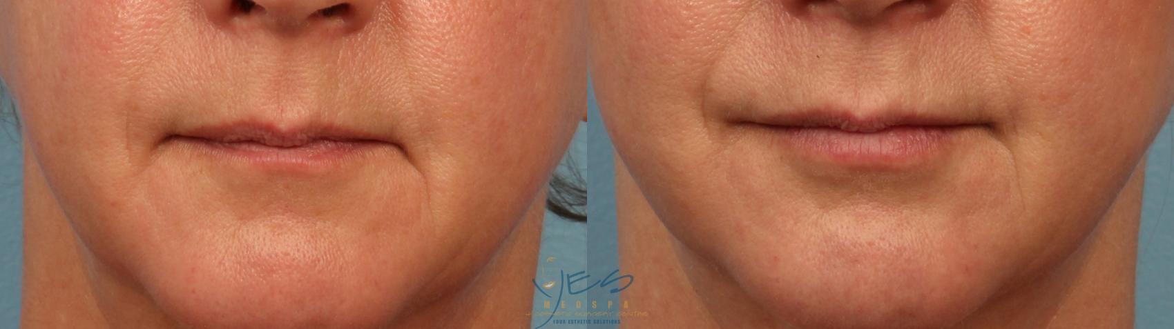 Before & After Dermal Fillers Case 361 Front View in Vancouver, BC