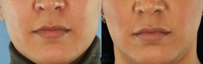 Before & After Dermal Fillers Case 408 Front - Lips View in Vancouver, BC