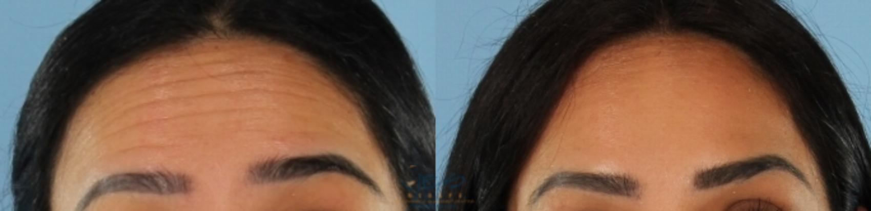 Before & After Dermal Fillers Case 408 Front - Raised Brow View in Vancouver, BC