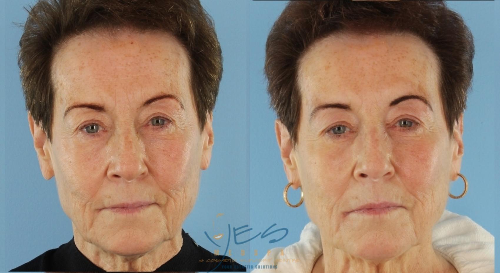 Before & After Dermal Fillers Case 412 Front View in Vancouver, BC
