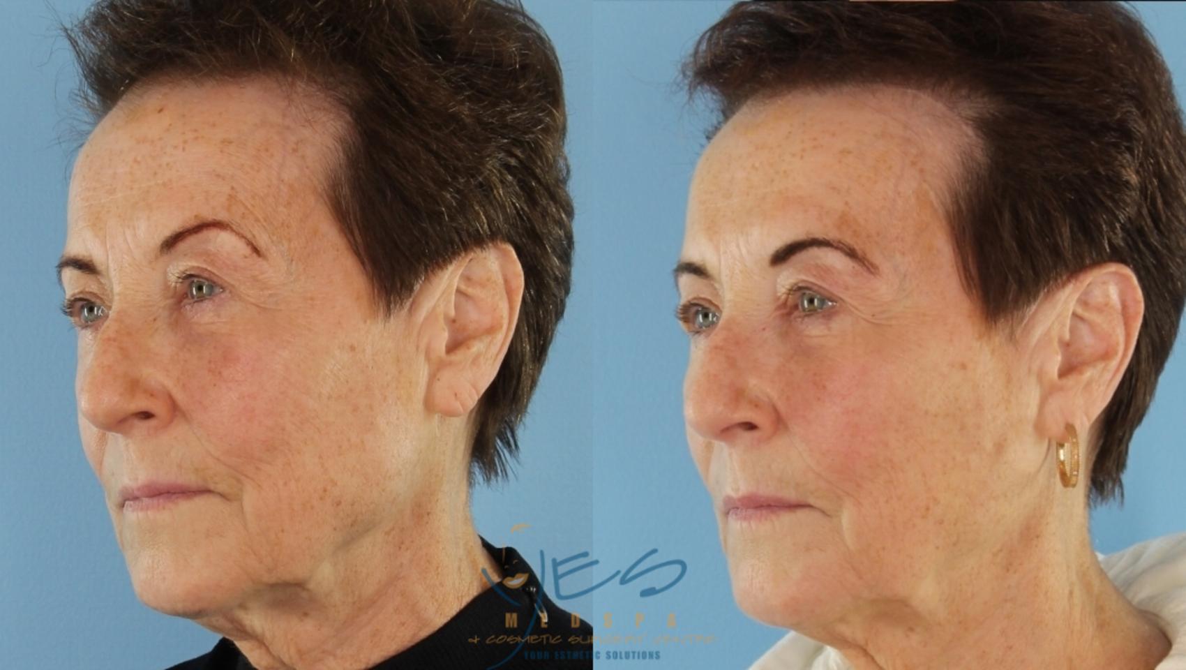 Before & After Dermal Fillers Case 412 Left Oblique View in Vancouver, BC