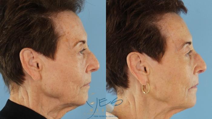 Before & After Dermal Fillers Case 412 Right Side View in Vancouver, BC