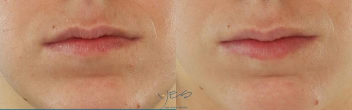 Before & After Dermal Fillers Case 436 Front View in Vancouver, BC