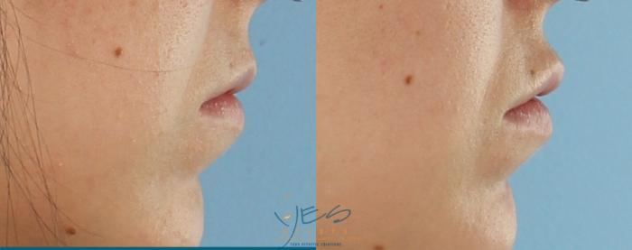 Before & After Dermal Fillers Case 436 Right Side View in Vancouver, BC