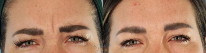 Before & After BOTOX COSMETIC® Treatments Case 443 Front - Botox View in Vancouver, BC