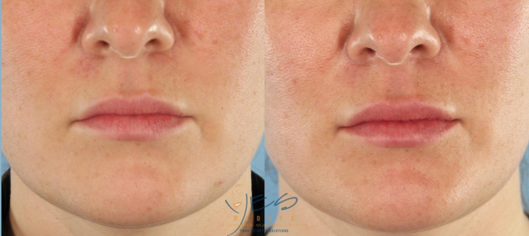 Before & After BOTOX COSMETIC® Treatments Case 443 Front View in Vancouver, BC