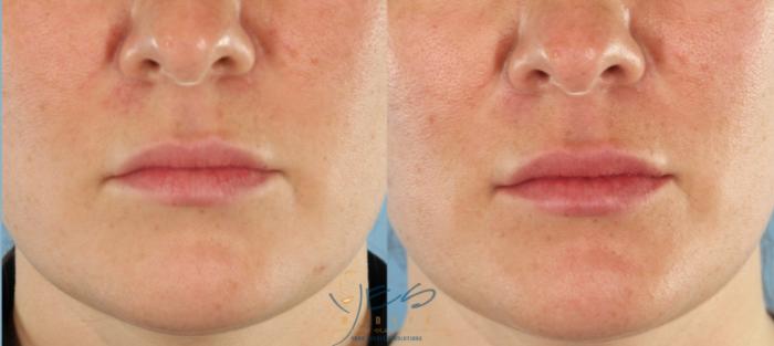 Before & After Dermal Fillers Case 443 Front View in Vancouver, BC