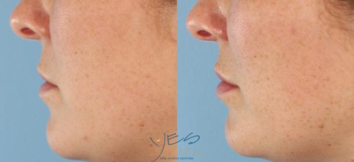 Before & After Dermal Fillers Case 443 Left Side View in Vancouver, BC