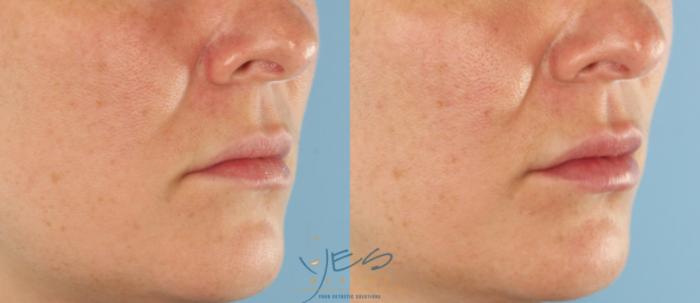Before & After Dermal Fillers Case 443 Right Oblique View in Vancouver, BC