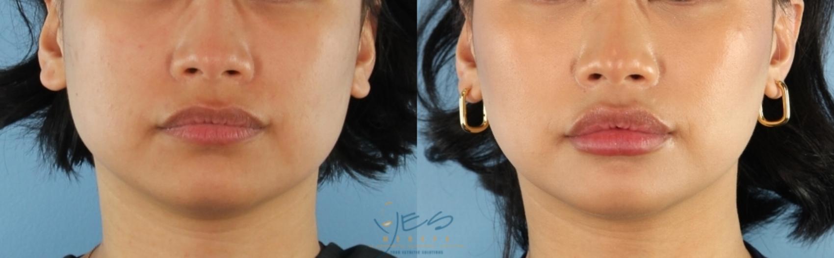 Before & After Dermal Fillers Case 461 Front View in Vancouver, BC
