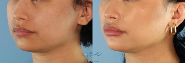 Before & After Dermal Fillers Case 461 Left Oblique View in Vancouver, BC