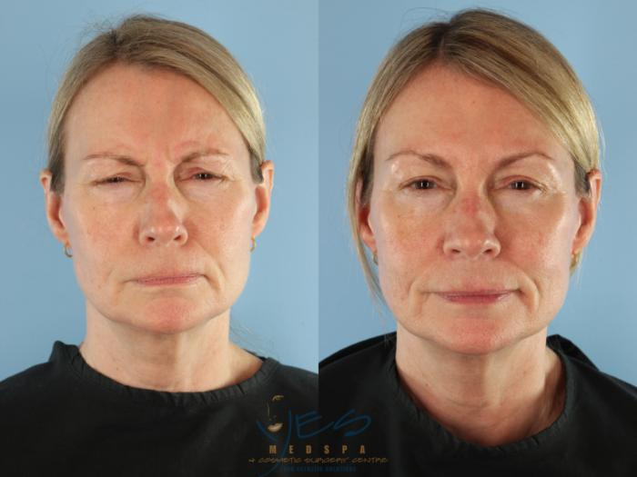 Before & After BOTOX COSMETIC® Treatments Case 507 botox - frown View in Vancouver, BC