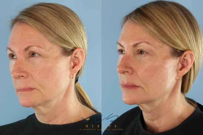 Before & After Dermal Fillers Case 507 Left Oblique View in Vancouver, BC
