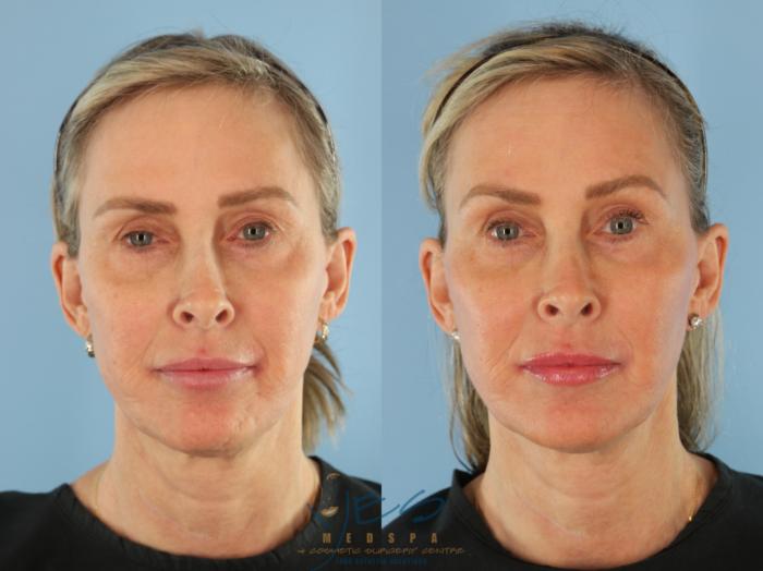 Before & After Dermal Fillers Case 508 Front View in Vancouver, BC