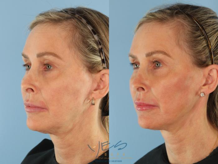 Before & After Dermal Fillers Case 508 Left Oblique View in Vancouver, BC