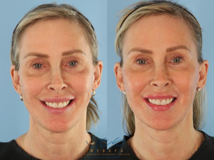 Before & After Dermal Fillers Case 508 Smile View in Vancouver, BC