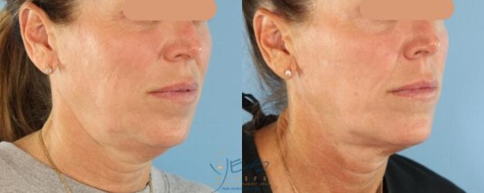 Before & After EMFACE Case 459 Right Oblique View in Vancouver, BC