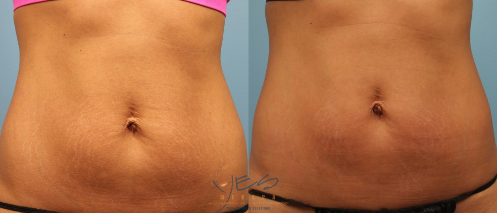 Before & After Evolve Tite / Venus BodyFx Case 213 View #1 View in Vancouver, BC