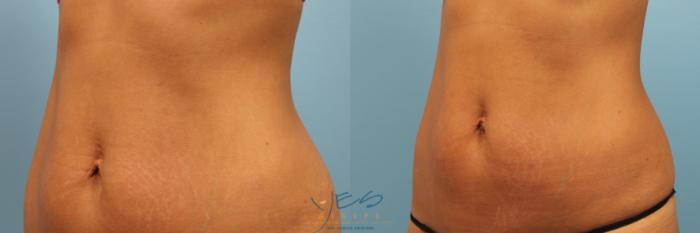Before & After Evolve Tite / Venus BodyFx Case 213 View #2 View in Vancouver, BC