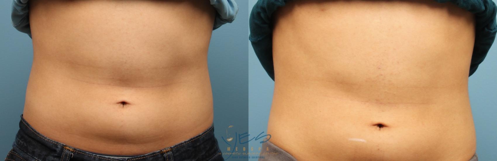 Before & After Evolve Tite / Venus BodyFx Case 225 Front View in Vancouver, BC