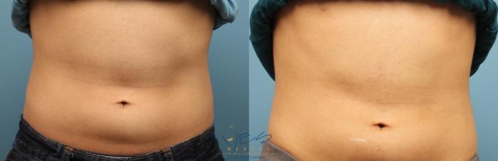Before & After Evolve Tite / Venus BodyFx Case 225 Front View in Vancouver, BC
