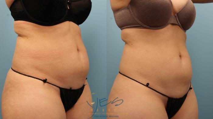 Before & After EVOLVE - TRIM/Transform Case 332 Right Oblique View in Vancouver, BC