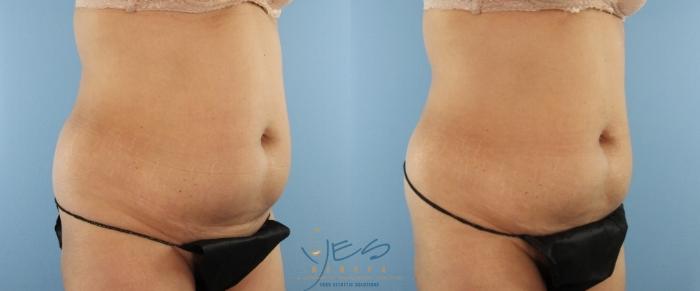 Before & After EVOLVE - TRIM/Transform Case 425 Right Oblique View in Vancouver, BC