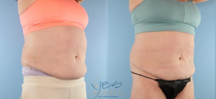 Before & After EVOLVE - TRIM/Transform Case 464 Right Oblique View in Vancouver, BC