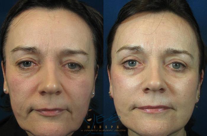 Before & After Face Lift & Neck Lift Case 115 View #1 View in Vancouver, BC