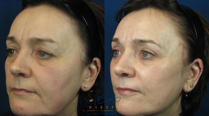 Before & After Face Lift & Neck Lift Case 115 View #2 View in Vancouver, BC