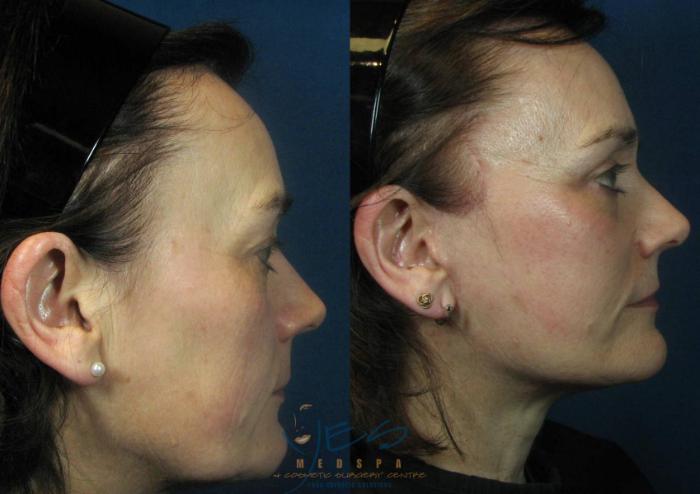 Before & After Face Lift & Neck Lift Case 115 View #3 View in Vancouver, BC