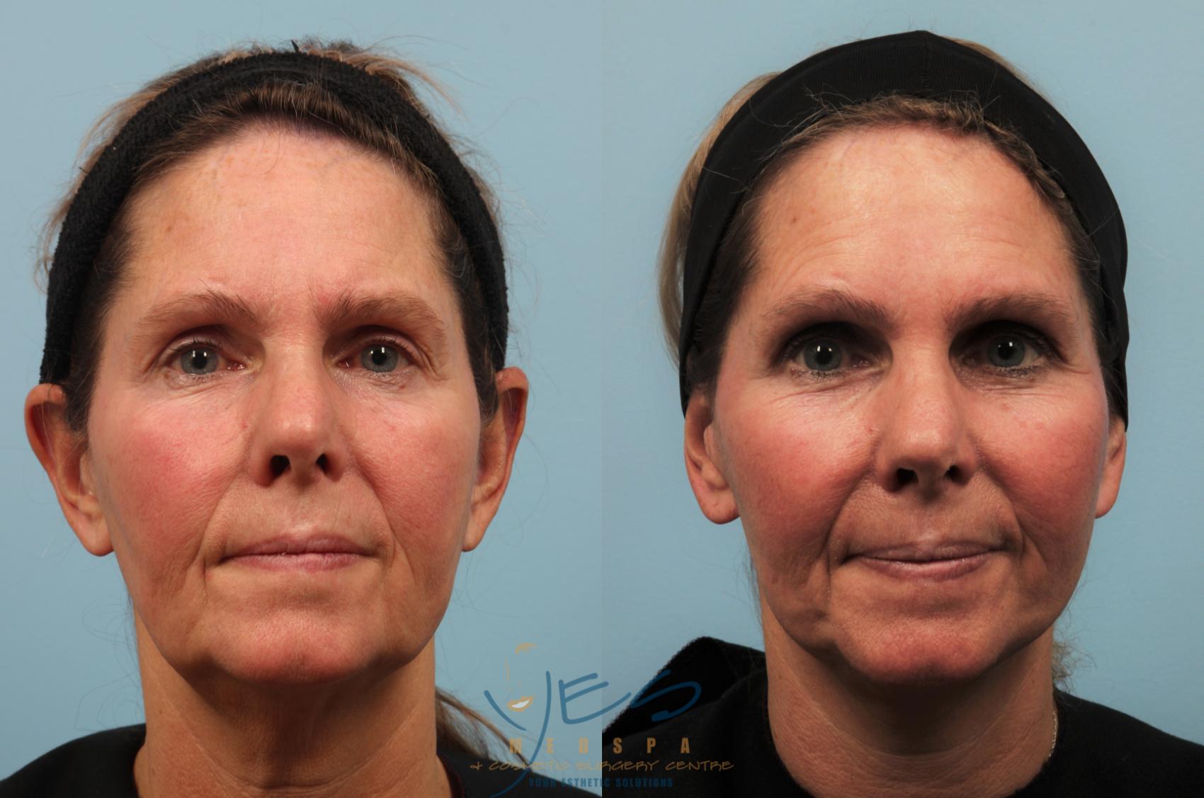 Before & After Face Lift & Neck Lift Case 201 View #1 View in Vancouver, BC