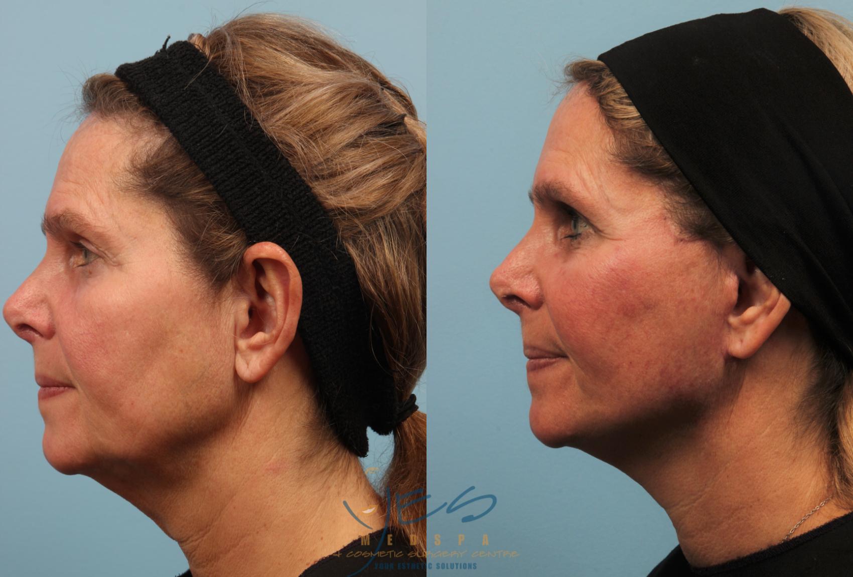 Before & After Face Lift & Neck Lift Case 201 View #2 View in Vancouver, BC